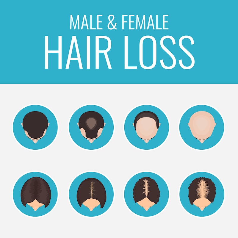 Illustration of male and female pattern hair loss to demonstrate the differences between the two conditions.