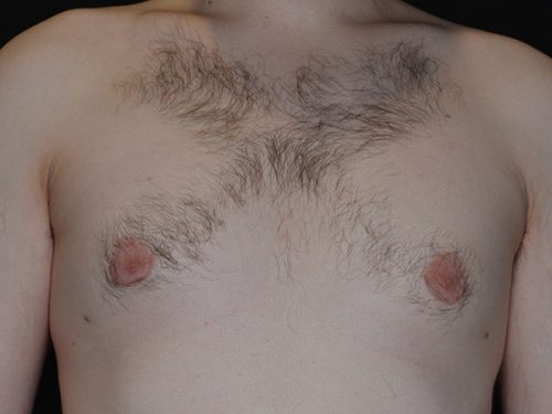 Gynecomastia 01 After