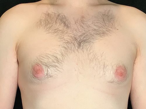 Gynecomastia 01 Before