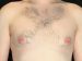 Gynecomastia 01 Before - Thumbnail