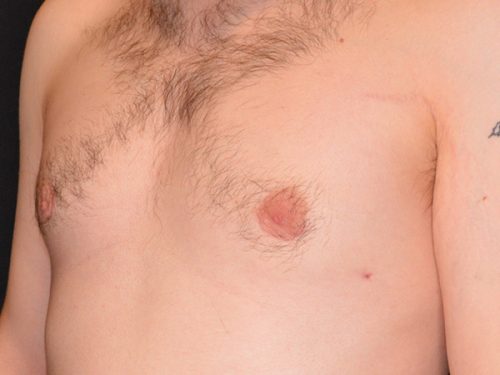 Gynecomastia 01 After - 3