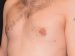 Gynecomastia 01 After - 3 - Thumbnail