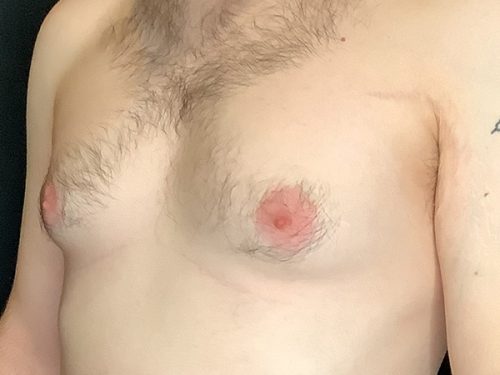 Gynecomastia 01 Before - 3