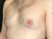 Gynecomastia 01 Before - 3 - Thumbnail