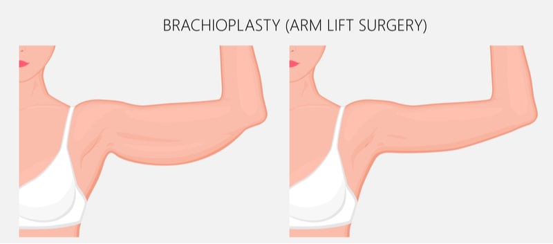 Illustration showing before and after results of arm lift surgery.