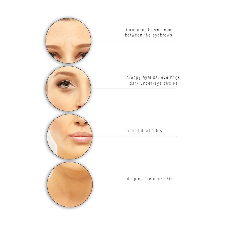 diagram of facial concerns that Juvederm can treat.