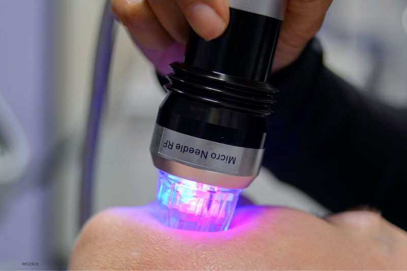 Your Most Frequently Asked Questions About Genius® RF Microneedling