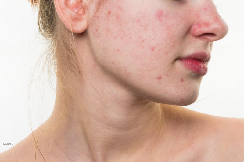 Profile of a young woman's face with numerous blemishes on the skin