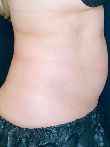 Coolsculpting 01 After - 2