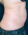 Coolsculpting 01 After - 2 - Thumbnail