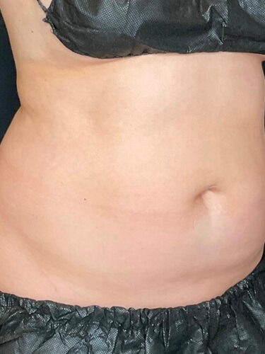 Coolsculpting 01 After