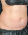 Coolsculpting 01 After - Thumbnail