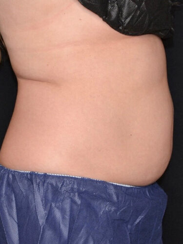 Coolsculpting 01 Before - 2