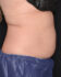 Coolsculpting 01 Before - 2 - Thumbnail