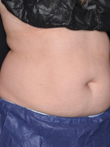 Coolsculpting 01 Before