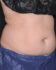 Coolsculpting 01 Before - Thumbnail