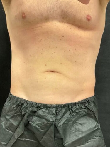 Coolsculpting 02 After