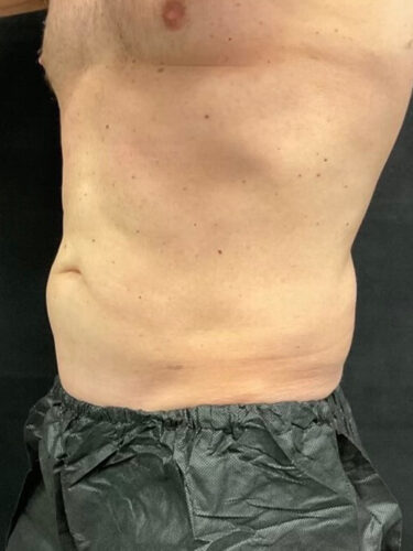 Coolsculpting 02 After - 3