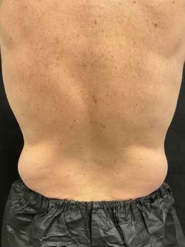 Coolsculpting 02 Before - 2