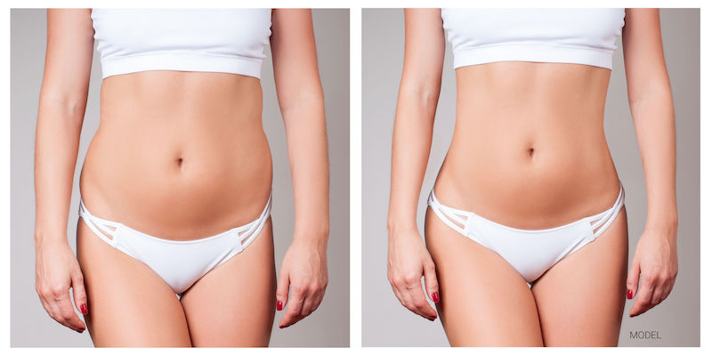 Is Liposuction a Weight Loss Tool?