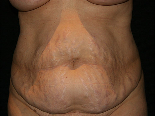 Tummy Tuck 08 Before