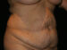 Tummy Tuck 08 Before - 2 - Thumbnail