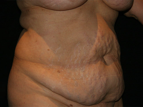 Tummy Tuck 08 Before - 2