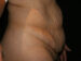 Tummy Tuck 08 Before - 3 - Thumbnail