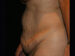 Tummy Tuck 08 Before - 4 - Thumbnail