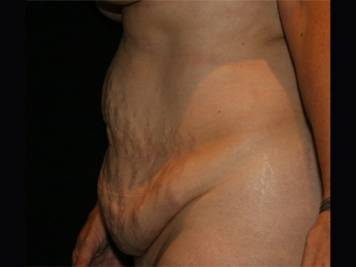 Tummy Tuck 08 Before - 4