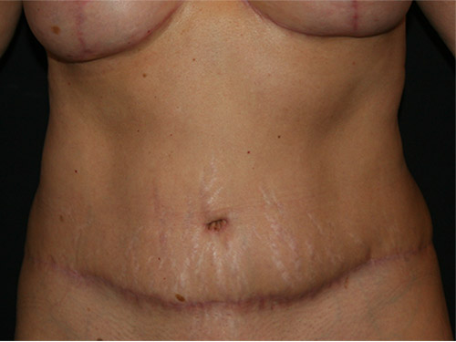 Tummy Tuck 08 After
