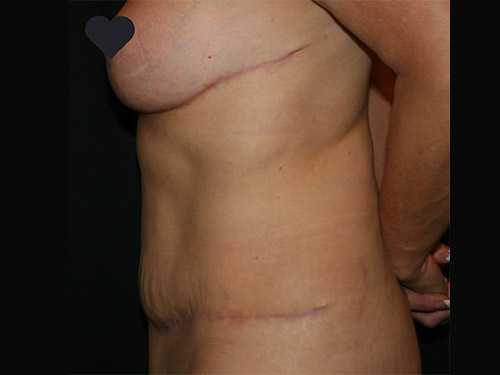 Tummy Tuck 08 After - 4