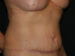 Tummy Tuck 08 After - 2 - Thumbnail