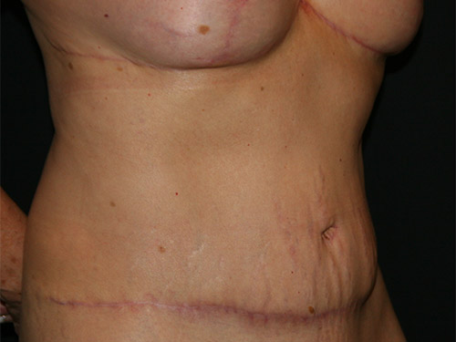 Tummy Tuck 08 After - 2