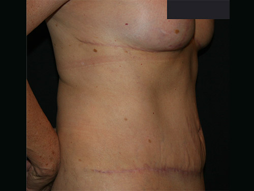 Tummy Tuck 08 After - 3