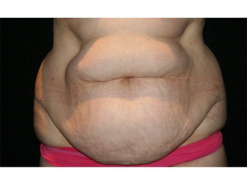 Tummy Tuck 09 Before