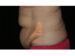 Tummy Tuck 09 Before - 2 - Thumbnail