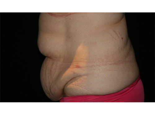 Tummy Tuck 09 Before - 2