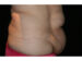 Tummy Tuck 09 Before - 3 - Thumbnail