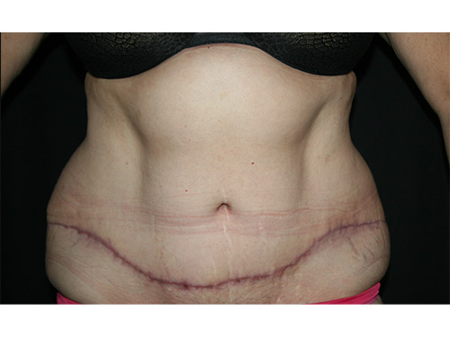 Tummy Tuck 09 After