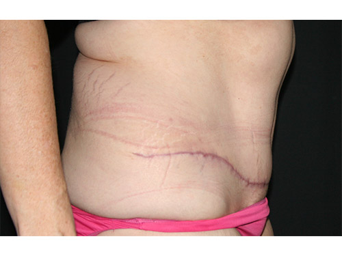 Tummy Tuck 09 After - 3