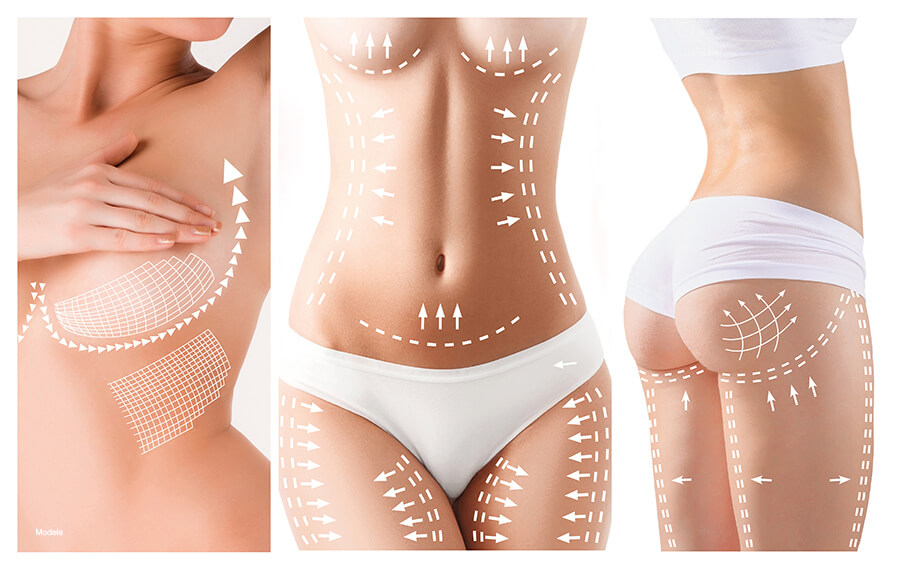 Three images of a woman (her chest, midsection, and buttocks) with arrows and markings on her skin to show how plastic surgery can correct cosmetic concerns