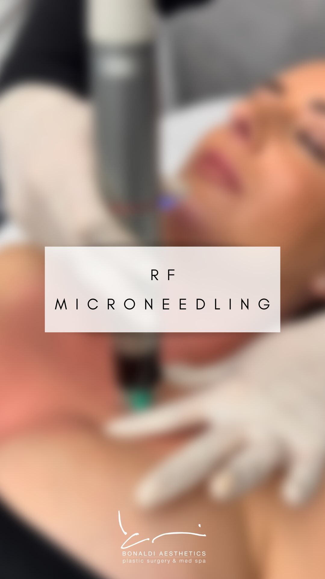 RF microneedling