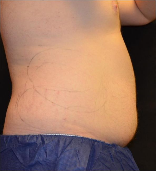 Before Coolsculpting