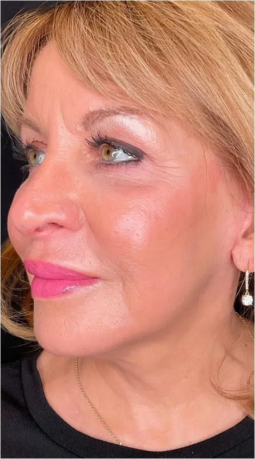Actual Bonaldi Aesthetics Patient After Facelift