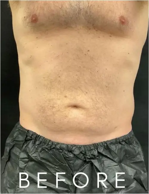 Before Gynecomastia Surgery