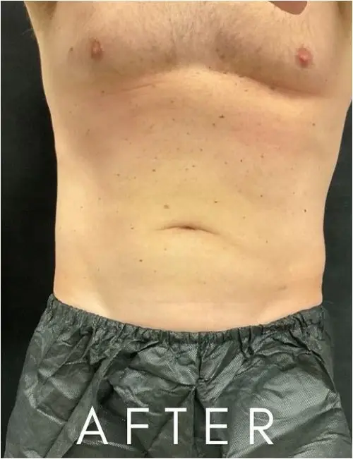 After Gynecomastia Surgery
