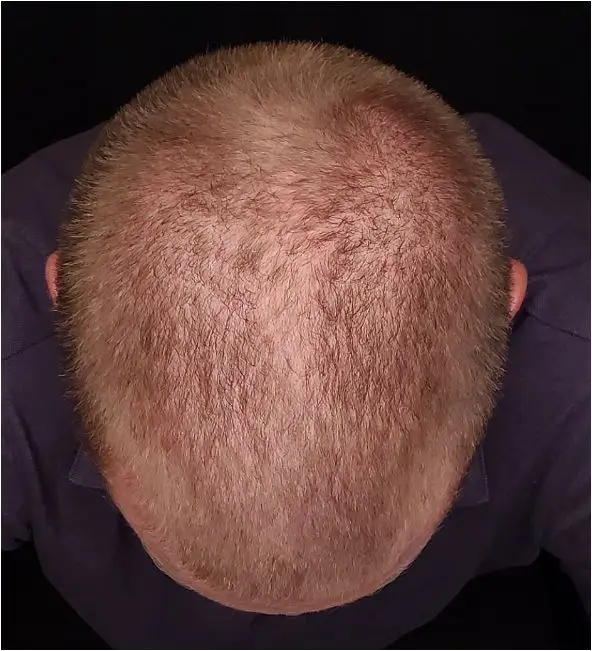 before prp hair restoration