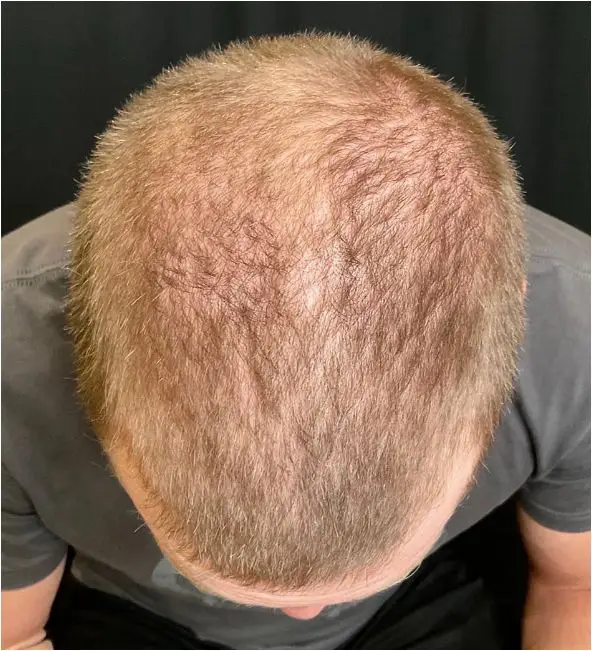 after prp hair restoration