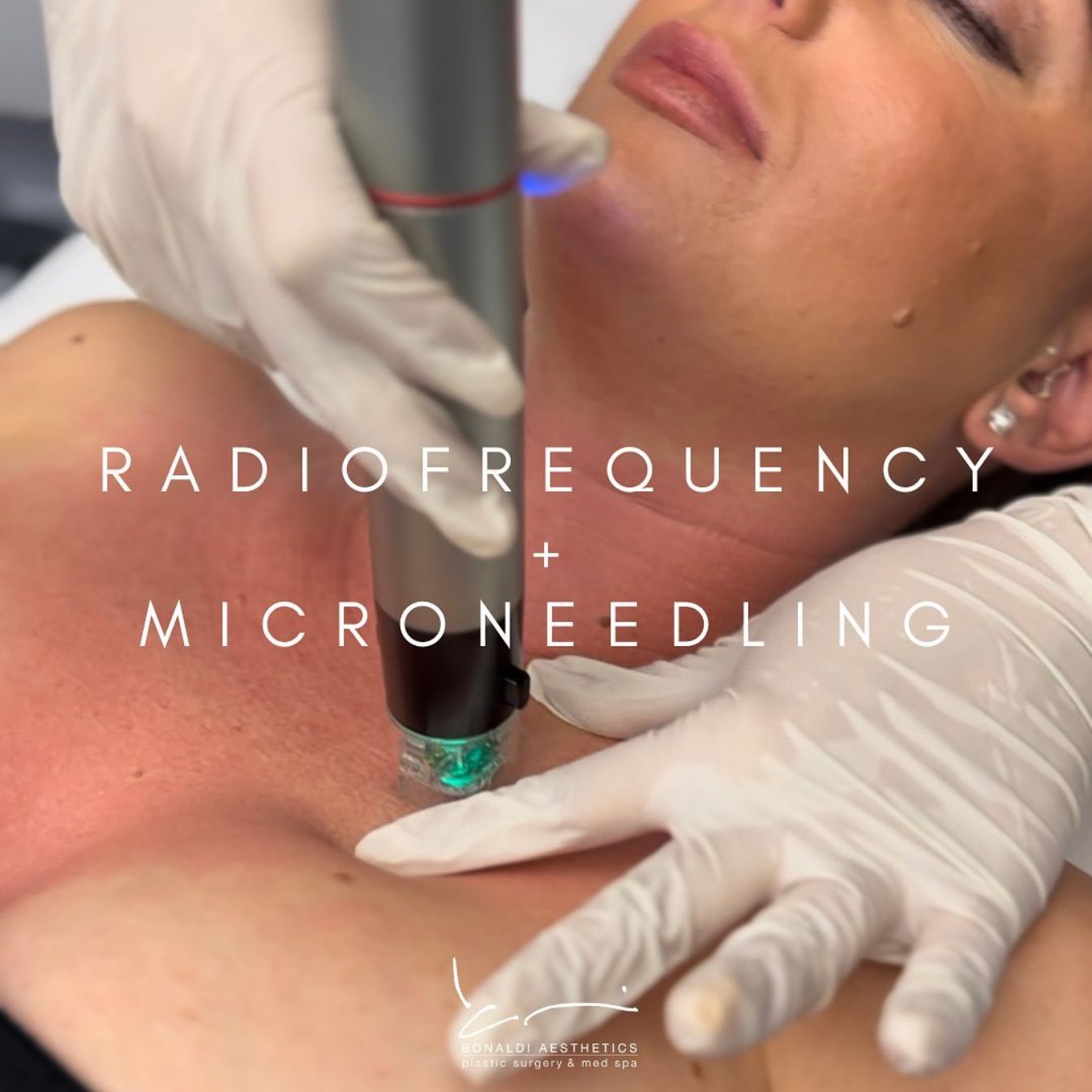 Radiofrequency and microneedling